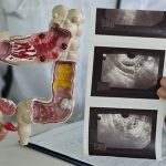 Mengapa Kanker Kolorektal Semakin Sering Ditemui pada Gen Z