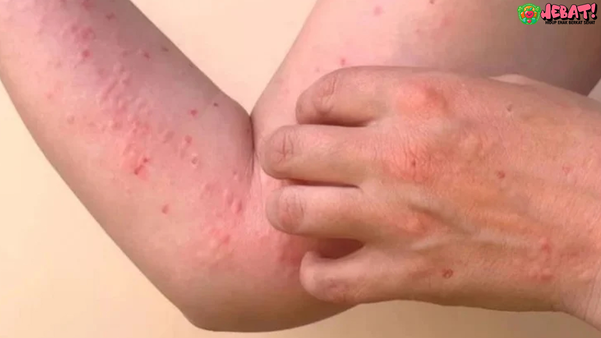 Chikungunya Serang Cianjur: Gejala Awal Sering Dianggap Remeh