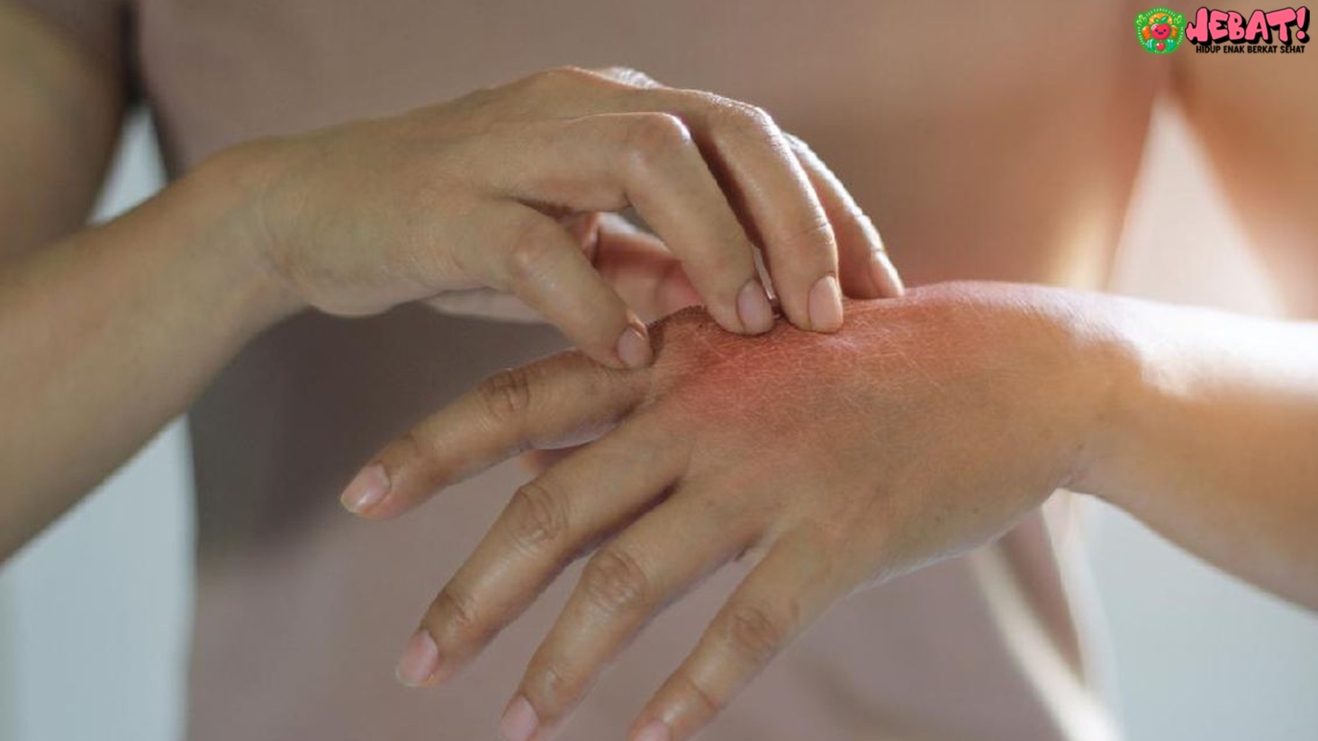 Antara Gatal dan Lemas: Waspadai Gejala Gangguan Imun Tubuh