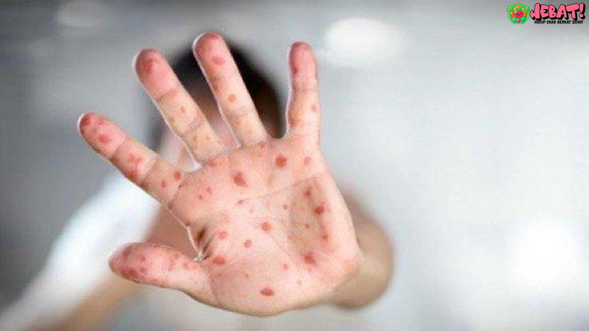 Kasus Mpox Meledak, WHO Nyatakan Darurat Kesehatan Dunia