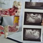 Kanker Usus Buntu: Ancaman Baru untuk Milenial dan Gen X