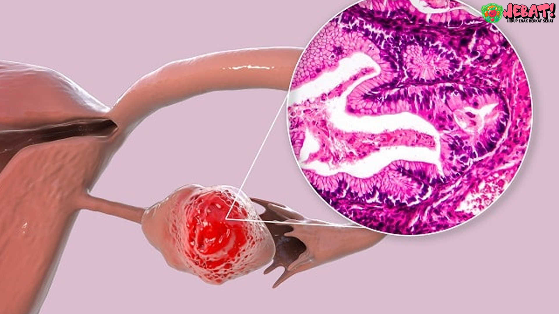 Mengungkap 3 Alasan Kanker Ovarium Terdiagnosis Lanjut