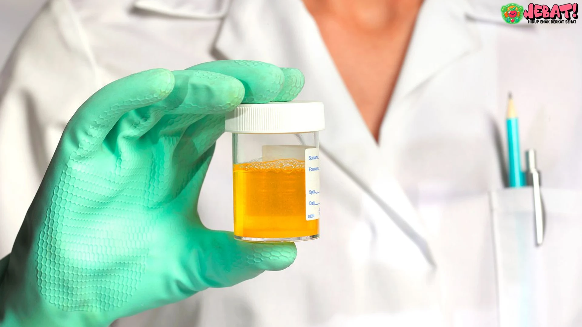 Warna Urine dan Gagal Ginjal: 5 Perubahan yang Perlu Kamu Tahu