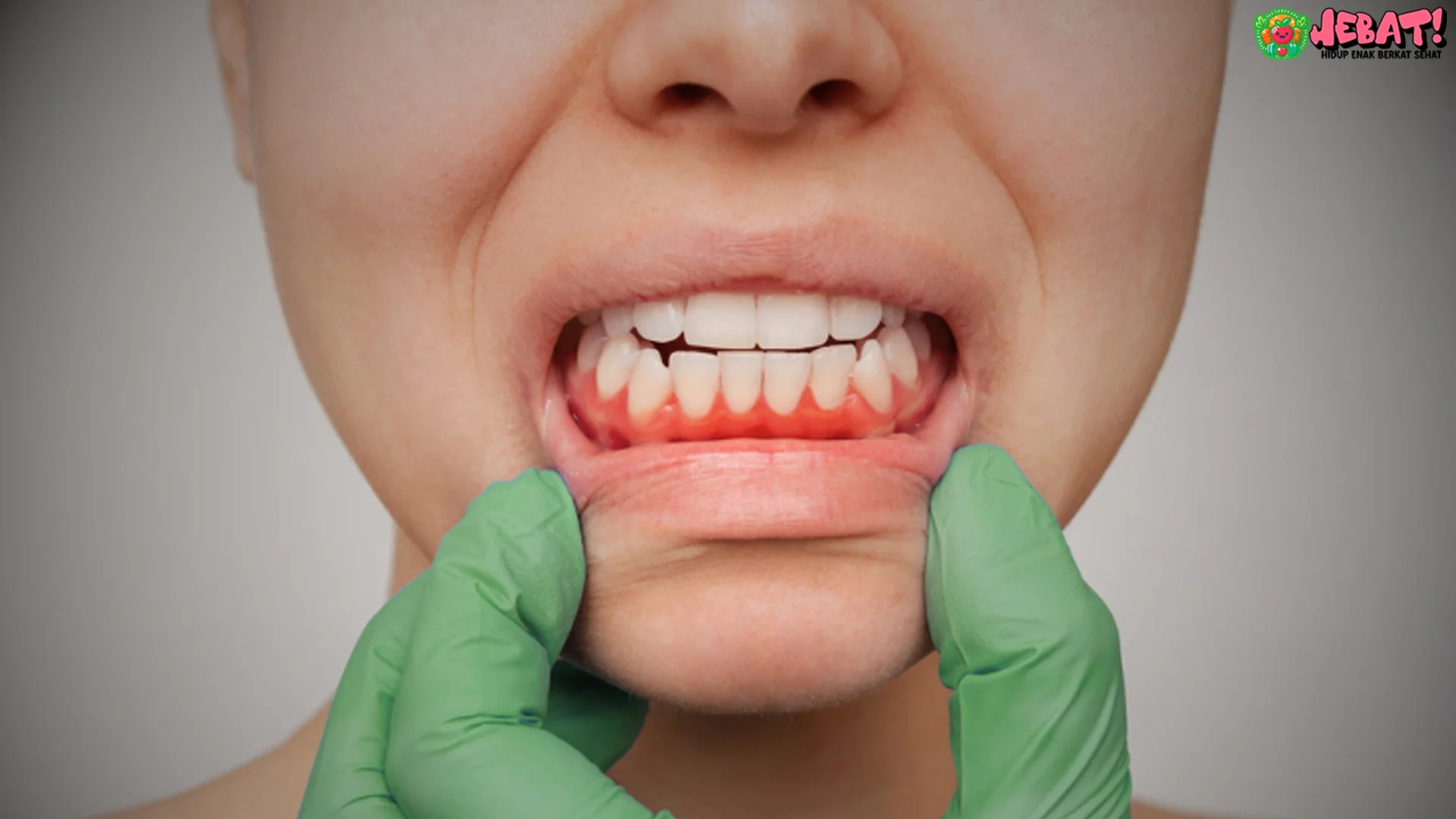 Gusi Bermasalah? 4 Alasan Kenapa Diabetes Bisa Ikut Mengintai