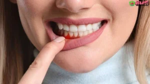 Gusi Bermasalah? 4 Alasan Kenapa Diabetes Bisa Ikut Mengintai