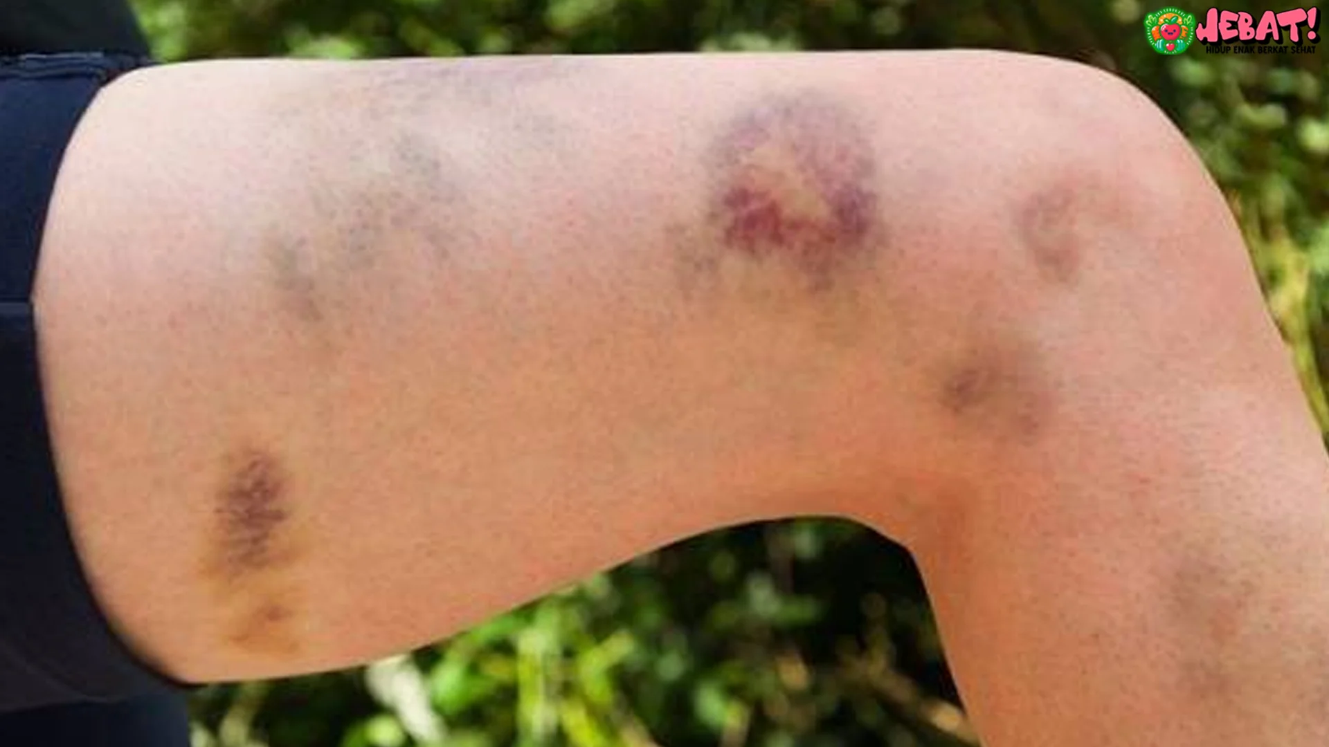 Mendadak Memar Tanpa Sebab dan 5 Gejala Kanker yang Perlu Dicatat