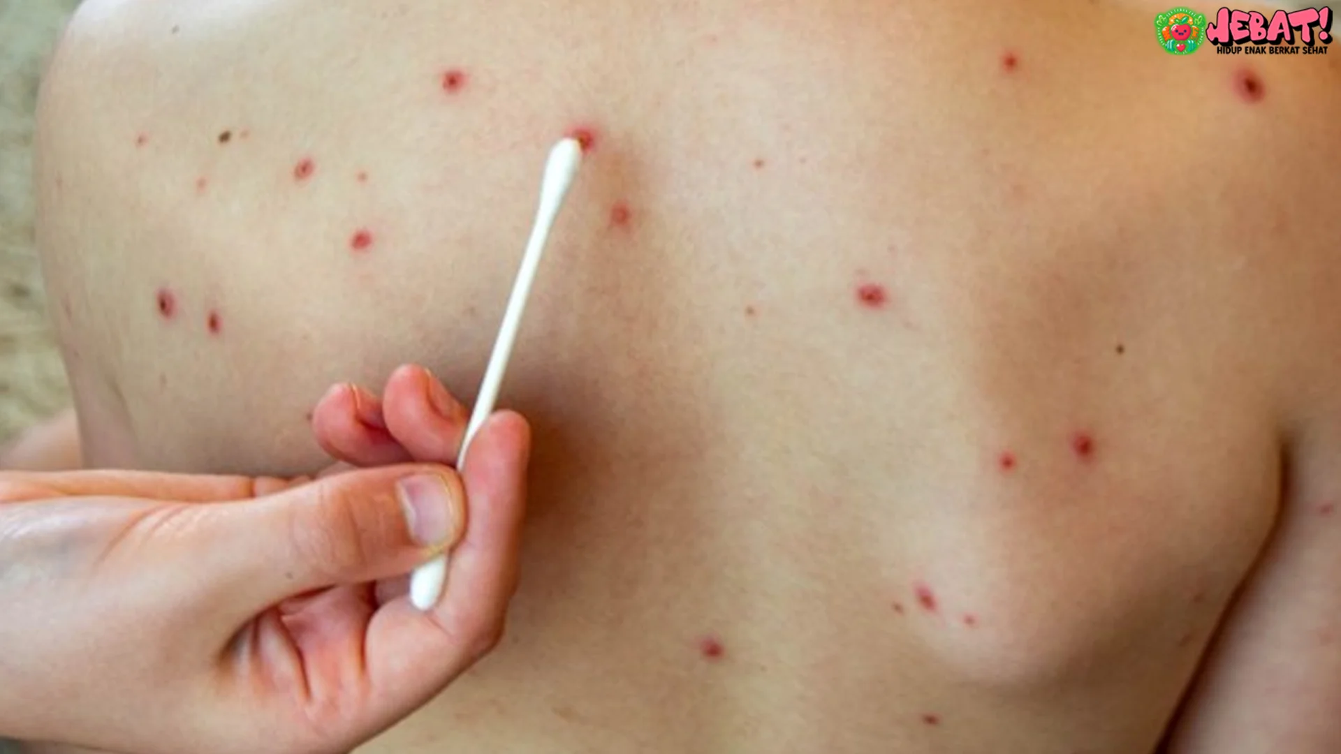 Pencegahan Cacar Air pada Anak Imunitas Khusus dan 5 Langkah