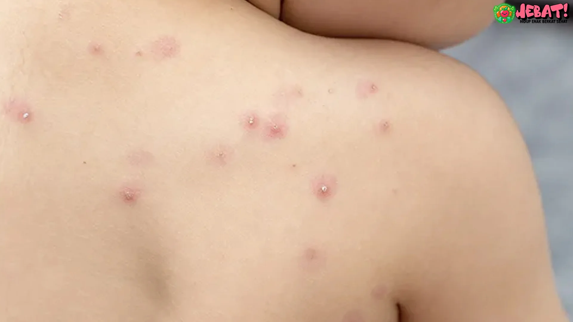 5 Alasan Penting Cacar Air Bisa Kambuh Lagi Berdasarkan Penjelasan Dokter