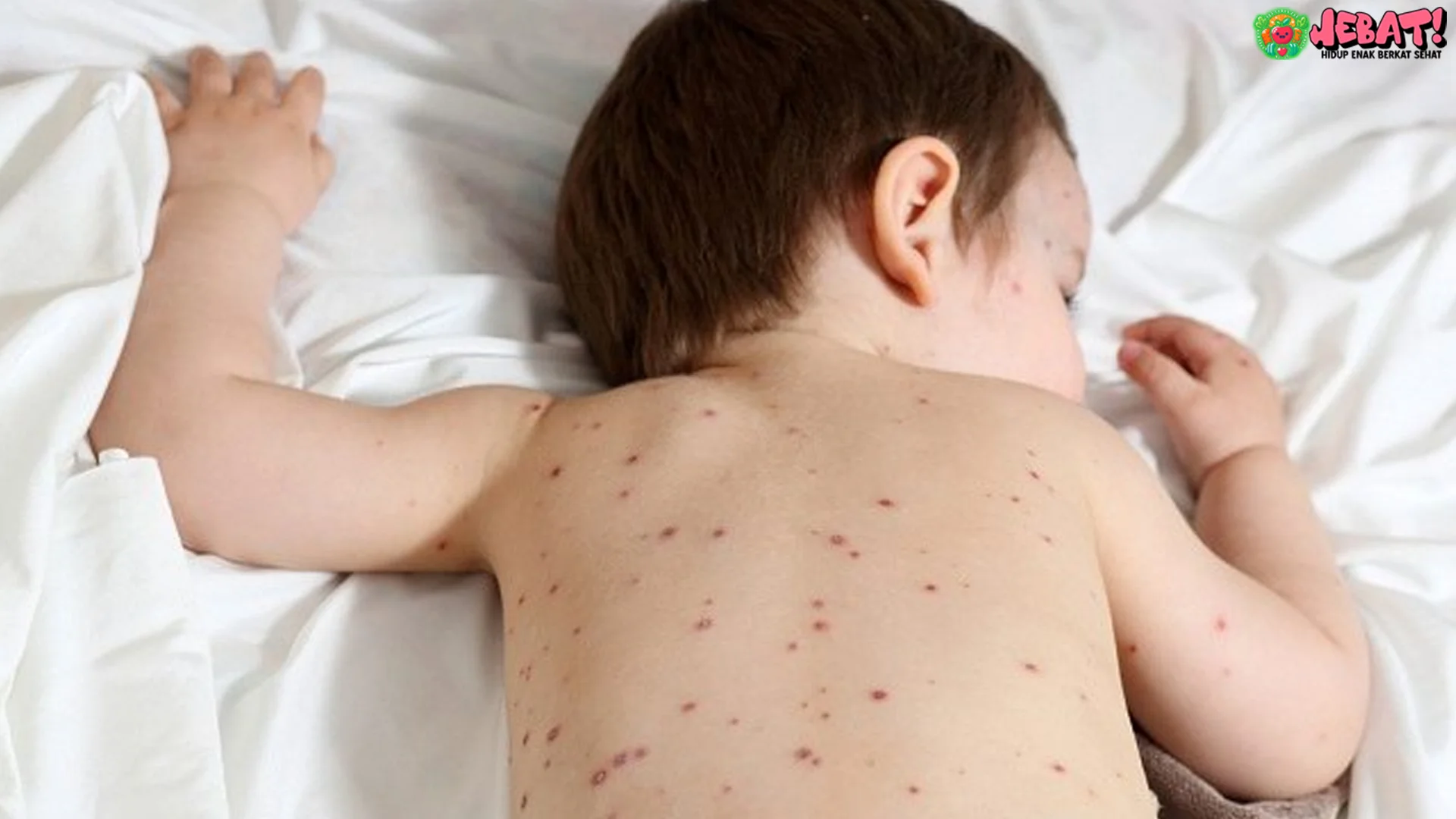 Pencegahan Cacar Air pada Anak Imunitas Khusus dan 5 Langkah