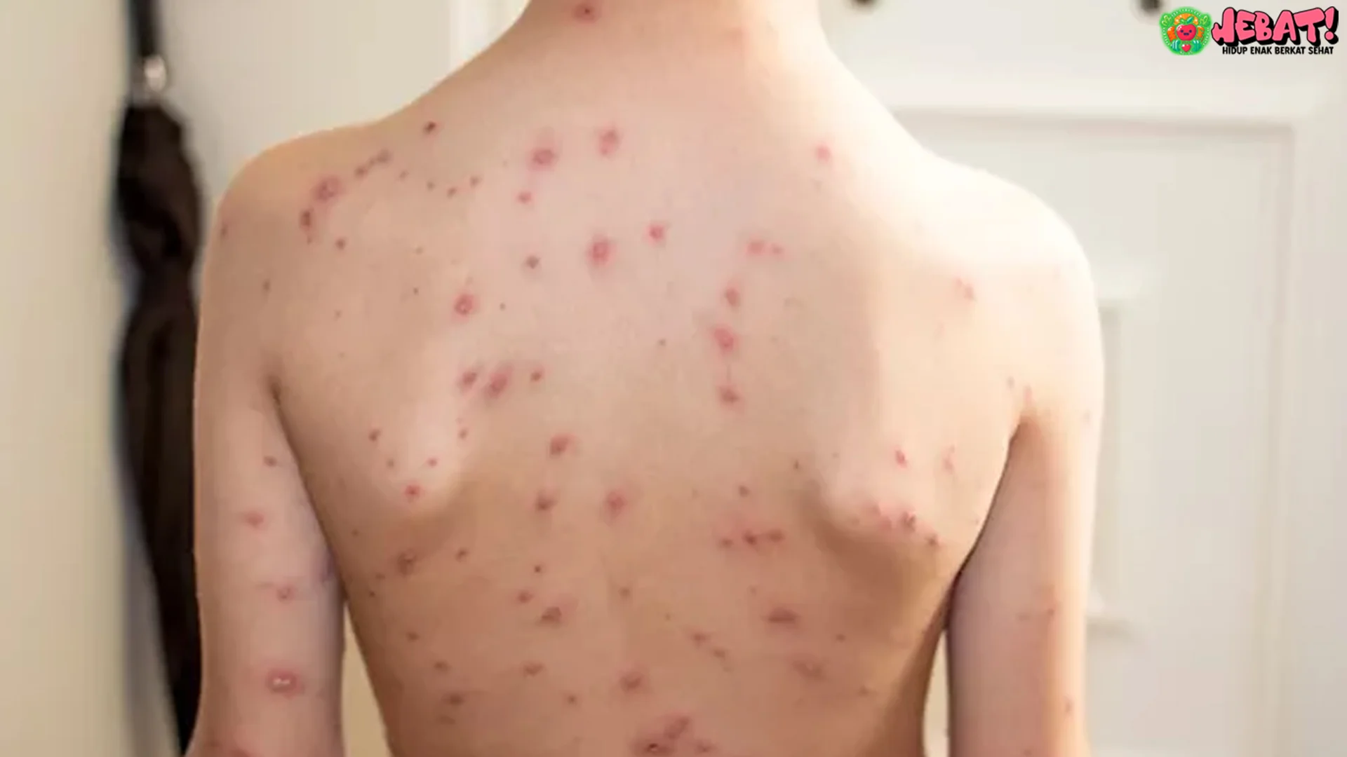 5 Alasan Penting Cacar Air Bisa Kambuh Lagi Berdasarkan Penjelasan Dokter