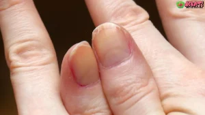 Kuku Tampak Bergelombang Ini 5 Alasan Medis yang Mendasari