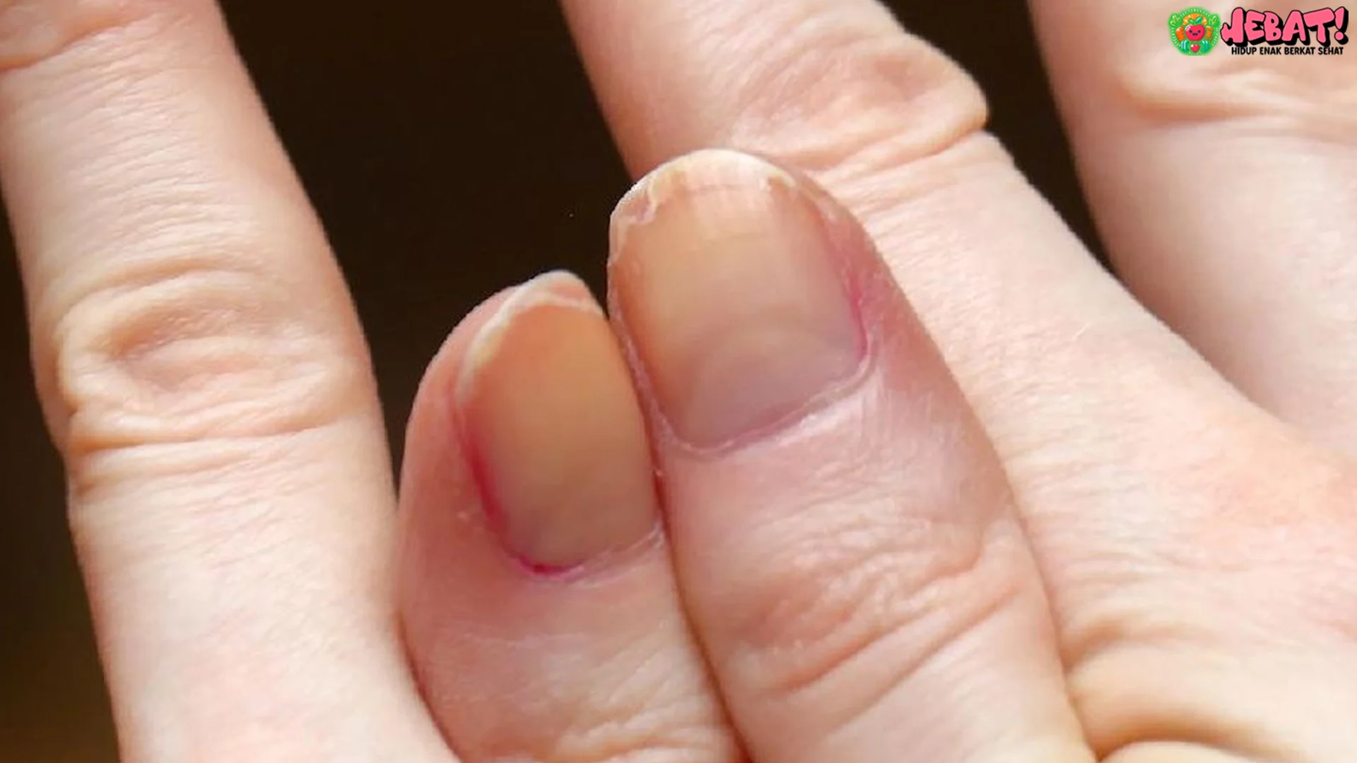 Kuku Tampak Bergelombang Ini 5 Alasan Medis yang Mendasari