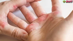 Gejala Kusta 5 Pertanyaan Penting Saat Konsultasi Bercak Putih