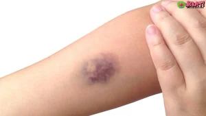 Kenali Memar Tubuh yang Membahayakan dengan 5 Tanda Penting