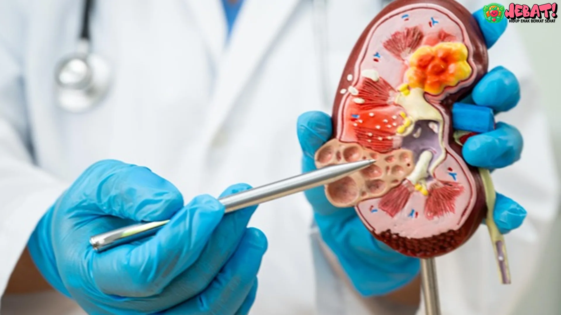 Keluhan Ini Bisa Jadi Pertanda Kanker Ginjal 4 Tingkat Risiko