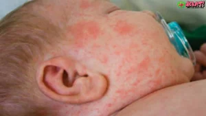 5 Risiko Campak pada Anak dan Cara Mengenali Gejala Dini