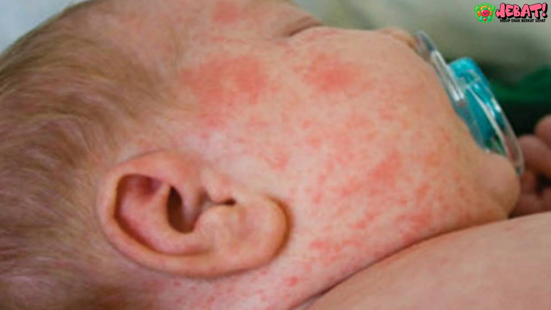 5 Risiko Campak pada Anak dan Cara Mengenali Gejala Dini