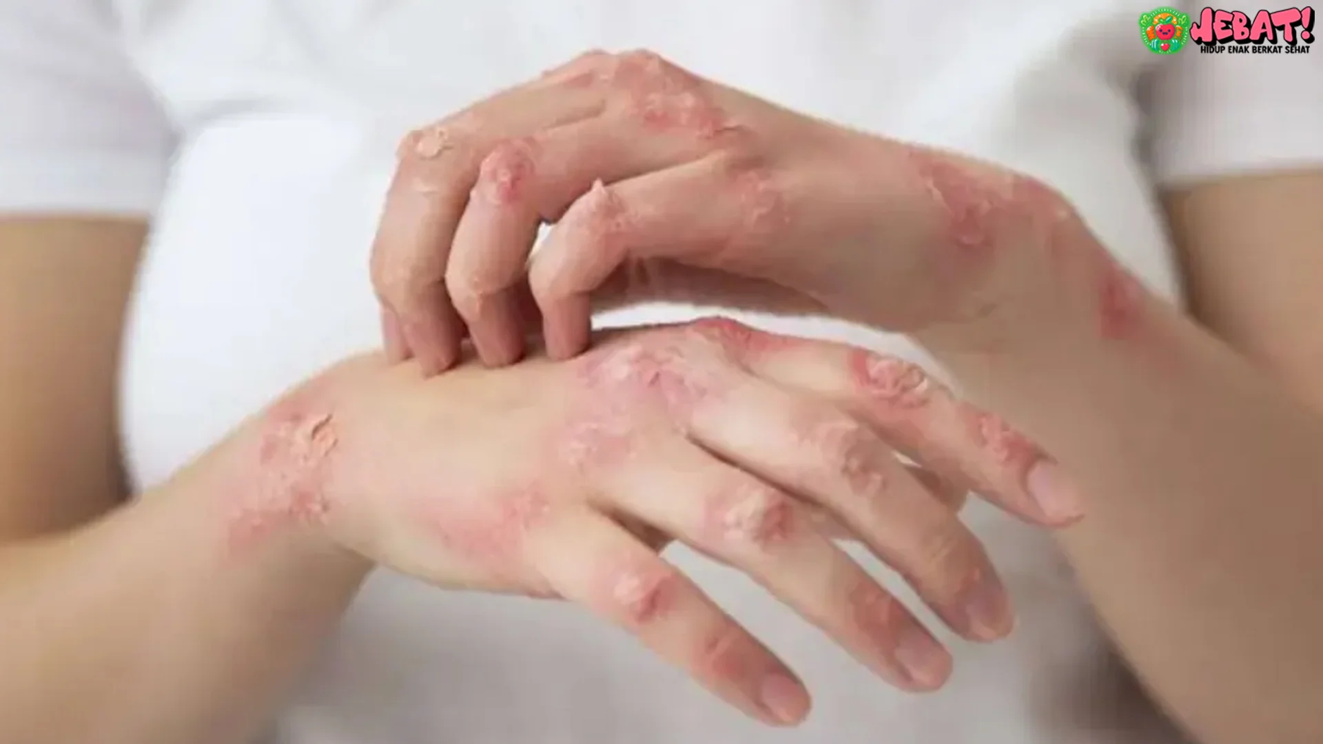 Gejala Kusta 5 Pertanyaan Penting Saat Konsultasi Bercak Putih