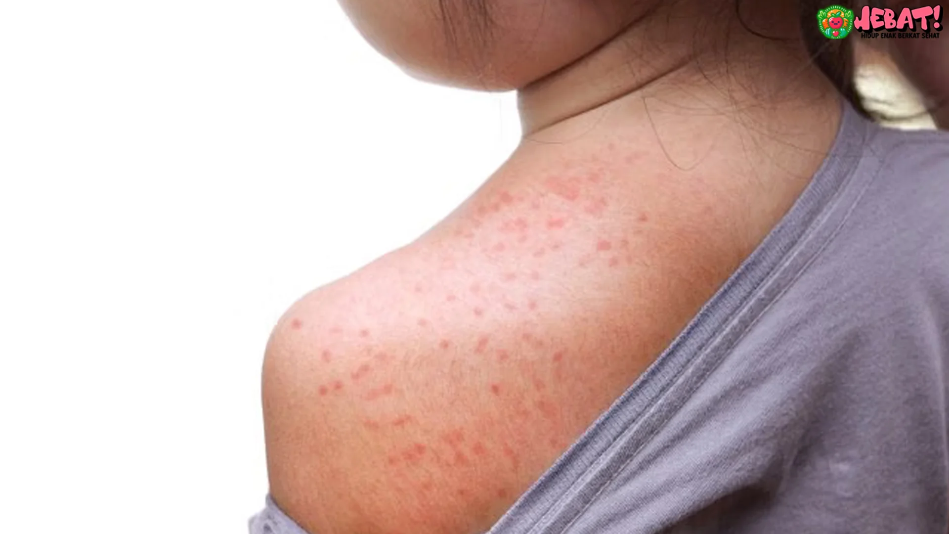 5 Risiko Campak pada Anak dan Cara Mengenali Gejala Dini