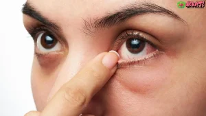 5 Gejala Asli Mata Ini Bisa Menjadi Pertanda Awal Penyakit Ginjal