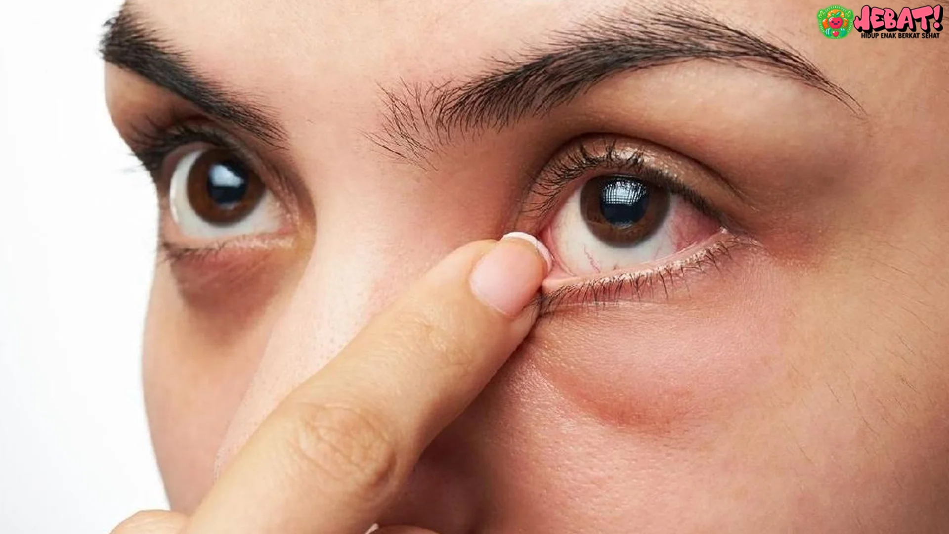 5 Gejala Asli Mata Ini Bisa Menjadi Pertanda Awal Penyakit Ginjal