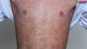 Ruam Merah Campak 5 Tanda Bahaya Pneumonia Mengintai