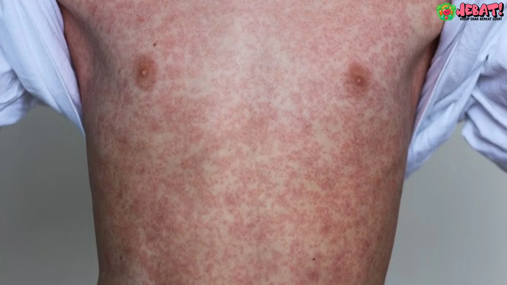 Ruam Merah Campak 5 Tanda Bahaya Pneumonia Mengintai