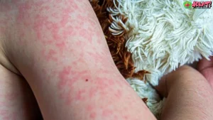 Campak Bisa Ganggu Otak 4 Cara Guru Besar FKUI Beri Wanti Wanti