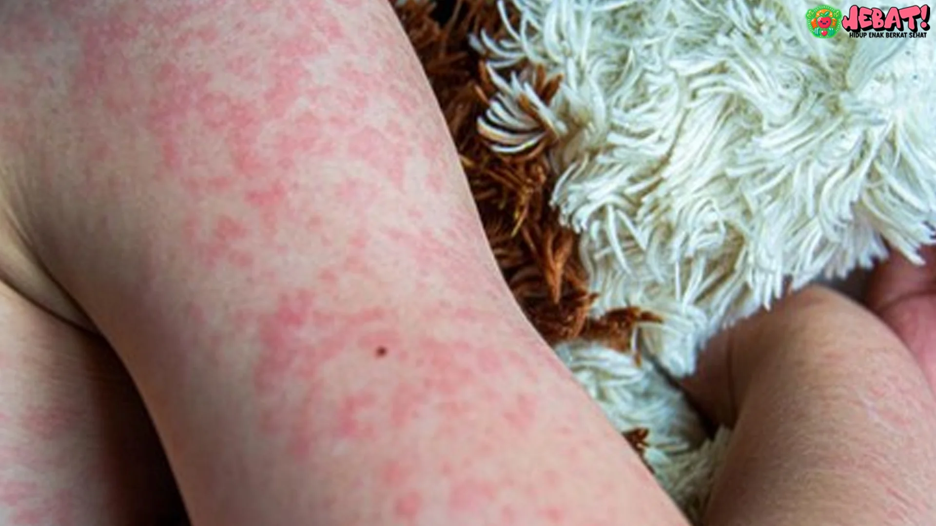 Campak Bisa Ganggu Otak 4 Cara Guru Besar FKUI Beri Wanti Wanti