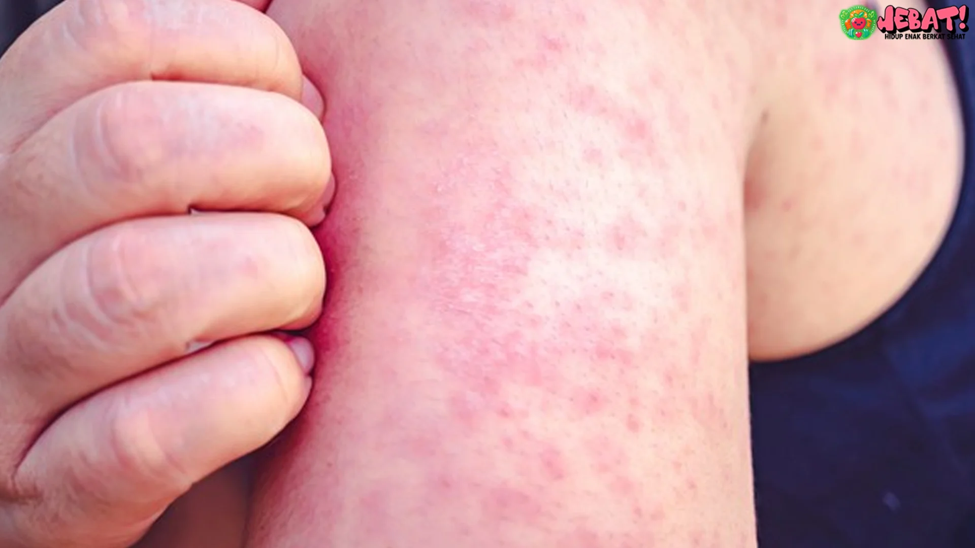 Ruam Merah Campak 5 Tanda Bahaya Pneumonia Mengintai 