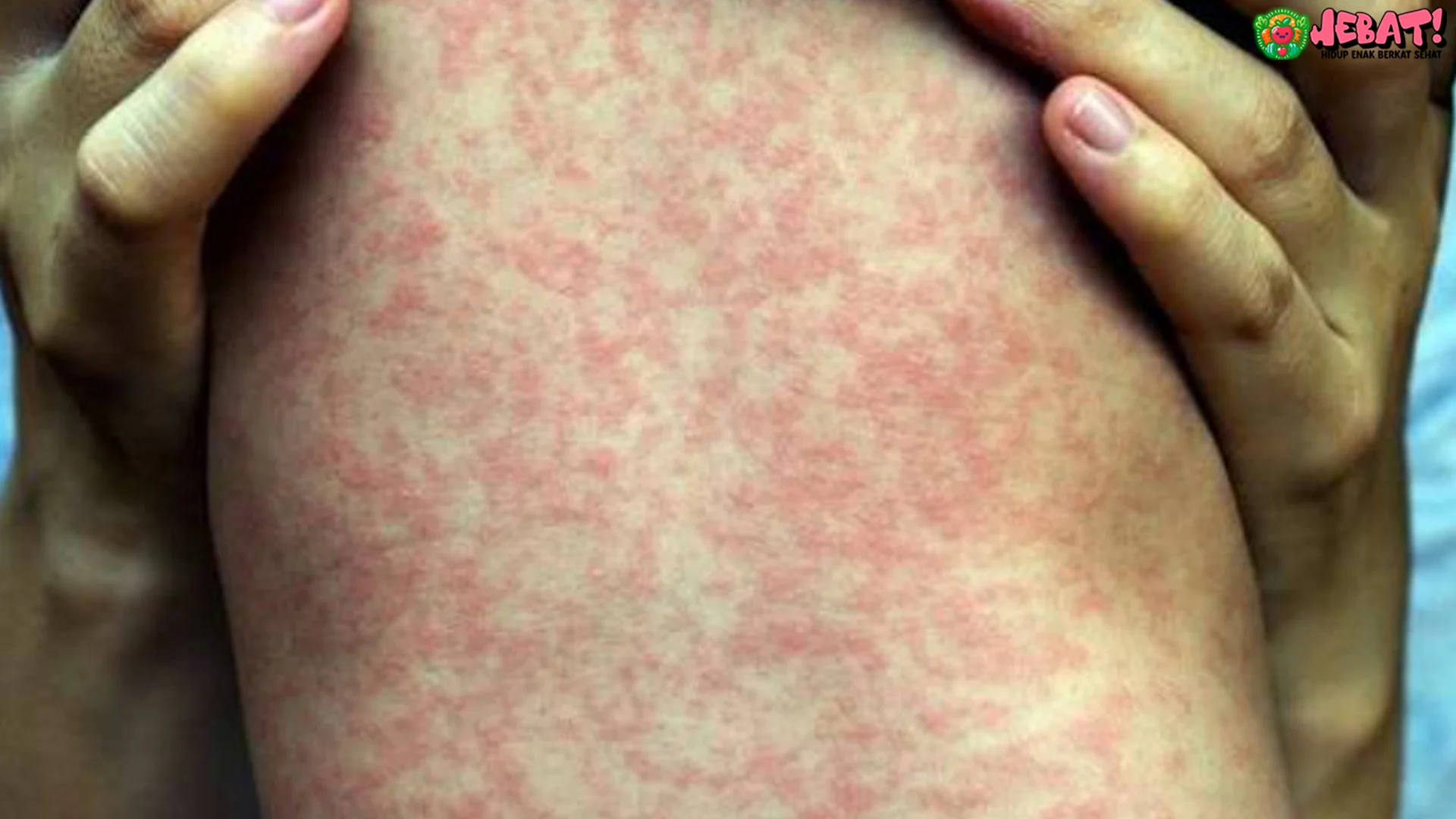 Campak Bisa Ganggu Otak 4 Cara Guru Besar FKUI Beri Wanti Wanti