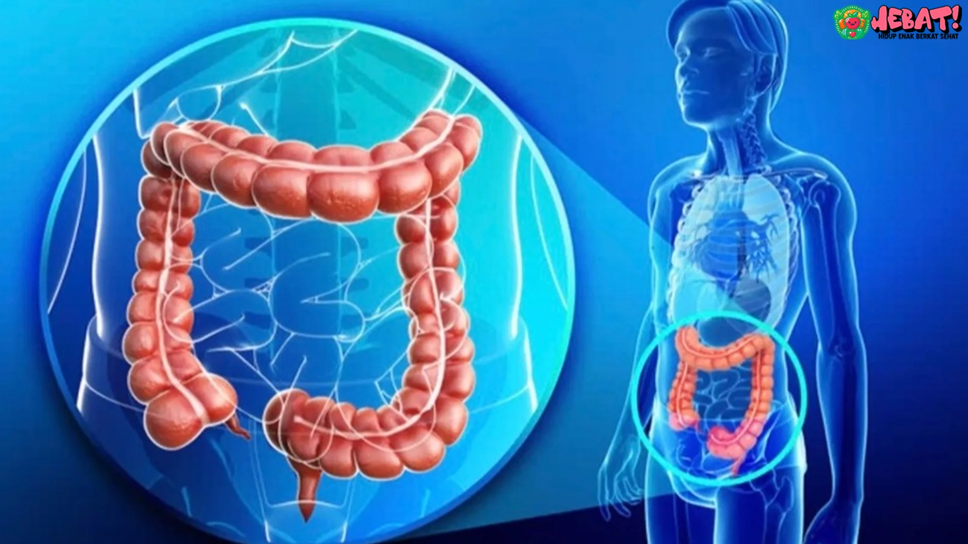 Kanker Kolorektal 4 Kelompok Paling Berisiko Wajib Waspada