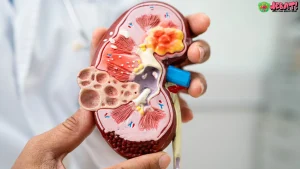 Terungkap 5 Penyebab Gagal Ginjal Makin Mengkhawatirkan RI